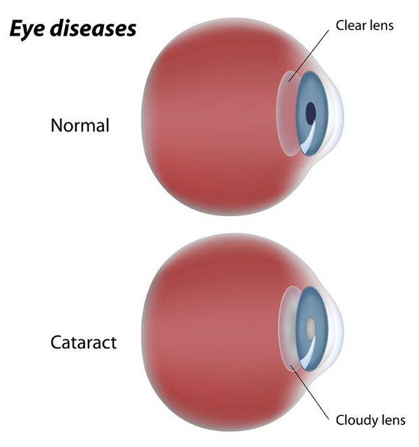 cataracts in valley stream