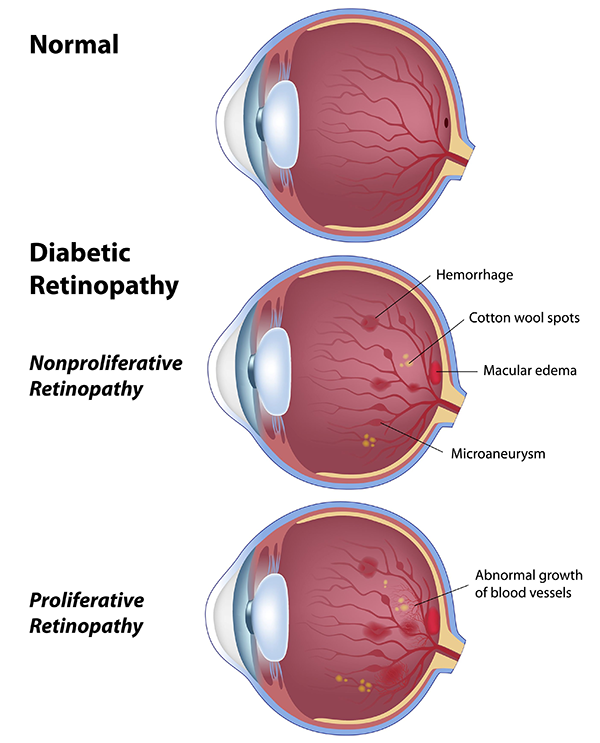 vision loss in valley stream