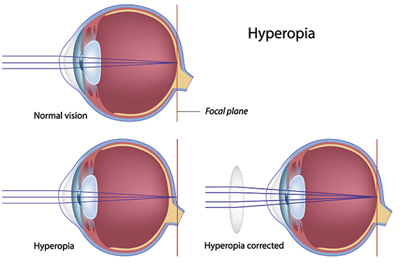 farsightedness in valley stream