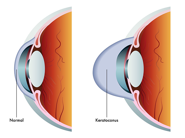 keratoconus in valley stream