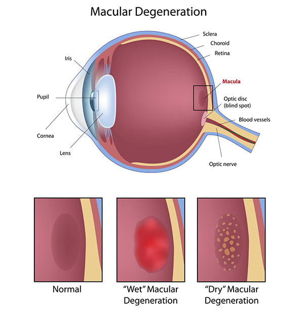 valley stream macular degeneration