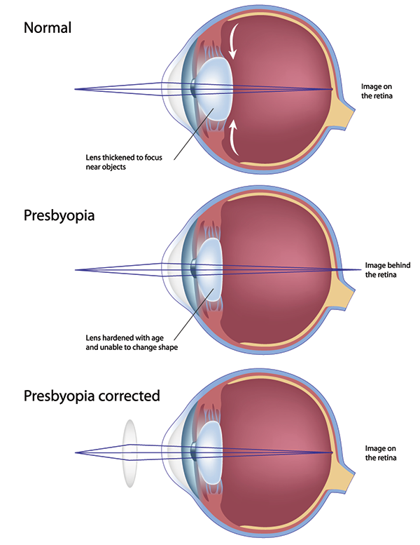 presbyopia in valley stream